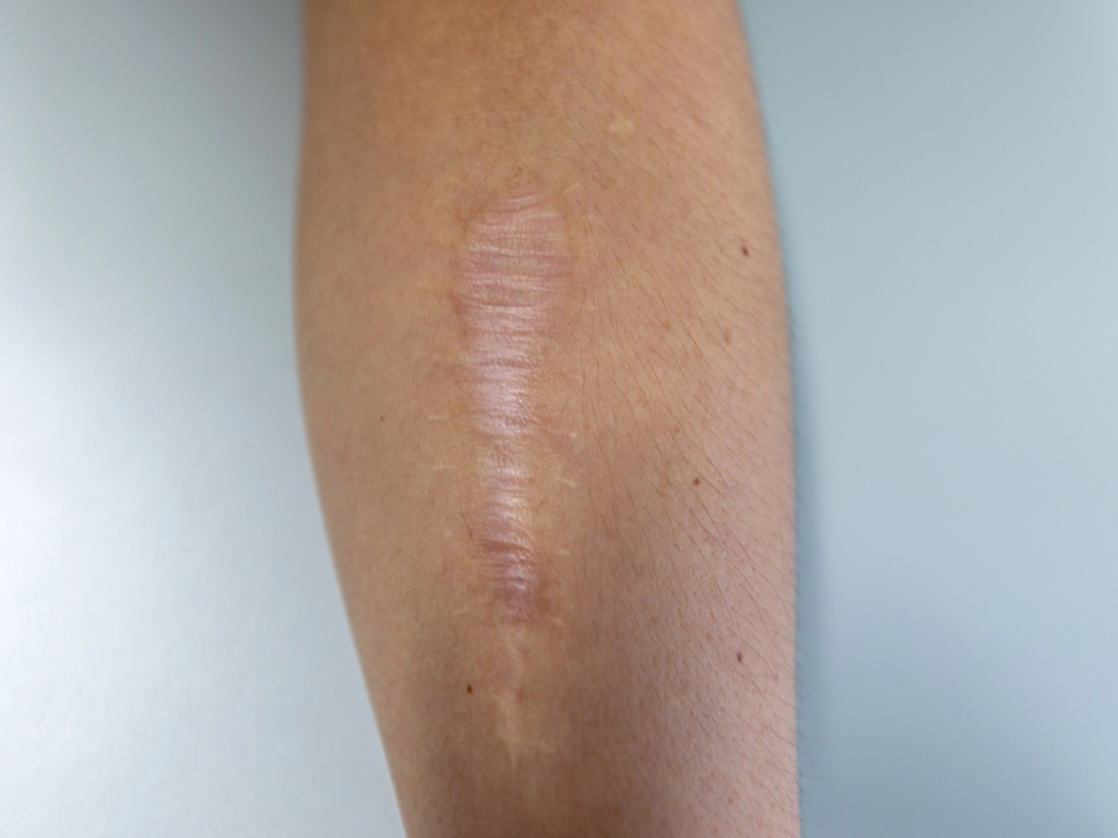 Atrofosisch litteken