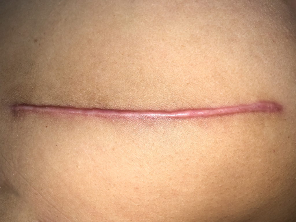 Hypertrofische litteken