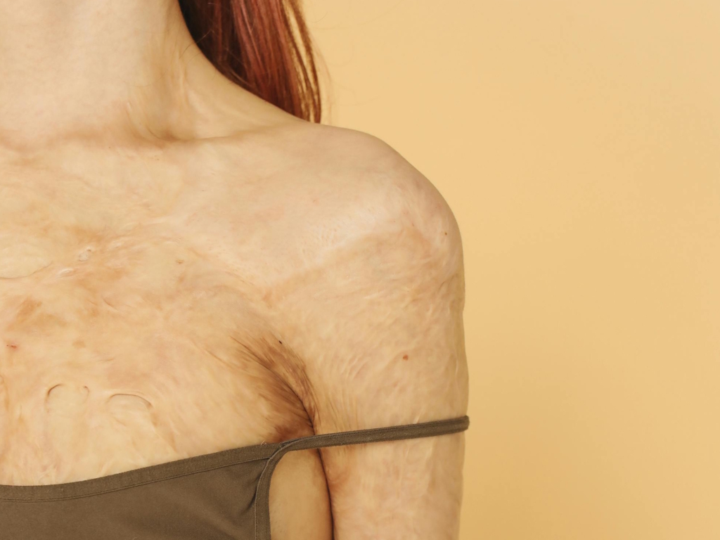 Litteken van brandwond