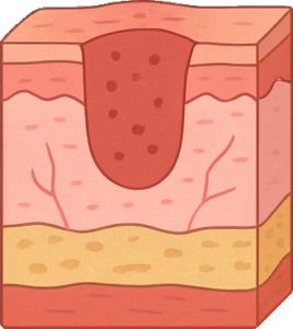 Wondstadium 2 - Ontstekingsfase