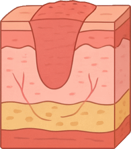 Wondstadium 3 - Proliferatiefase